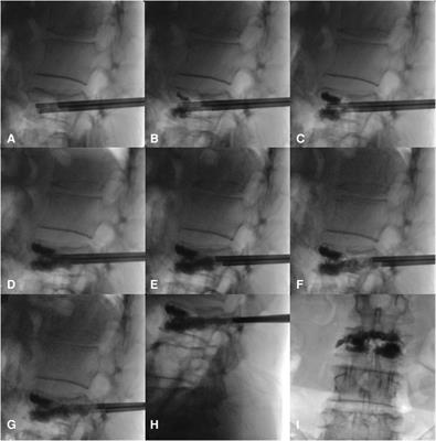 A mid- and long-term follow-up study on the bilateral pedicle anchoring technique with percutaneous vertebroplasty for the treatment of Kümmell's disease